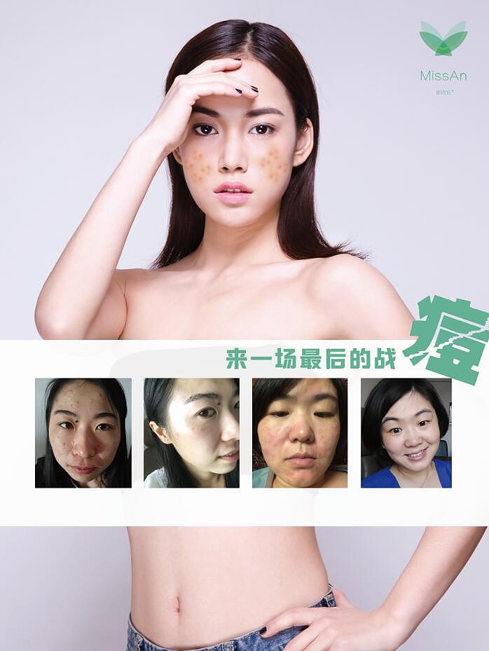 密诗安-祛痘效果（图ZMTA4MDM4NDIw） - 其他 - 站酷设计师张寂原创素材 - 站酷ZCOOL
