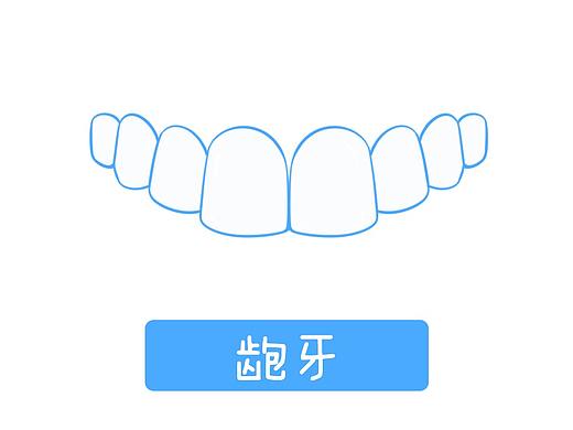 透明牙套