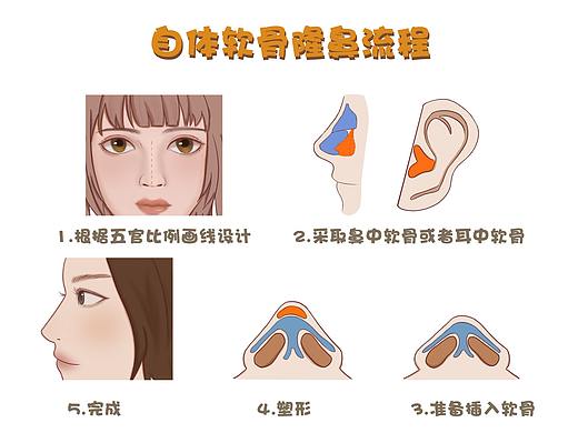 自体软骨隆鼻