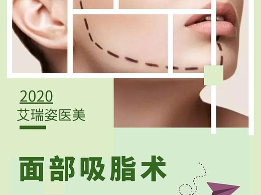 成都艾瑞姿-艾瑞姿医美-瘦脸-面部吸脂术