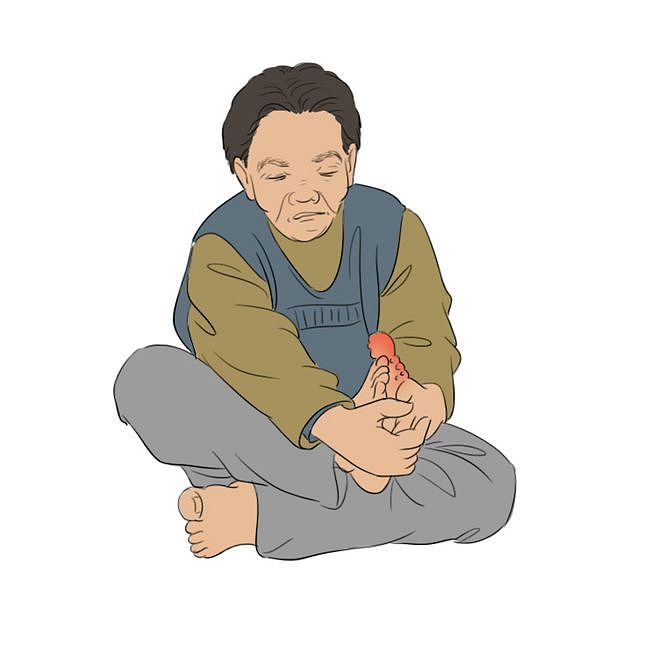 痛风疾病、身体、健康