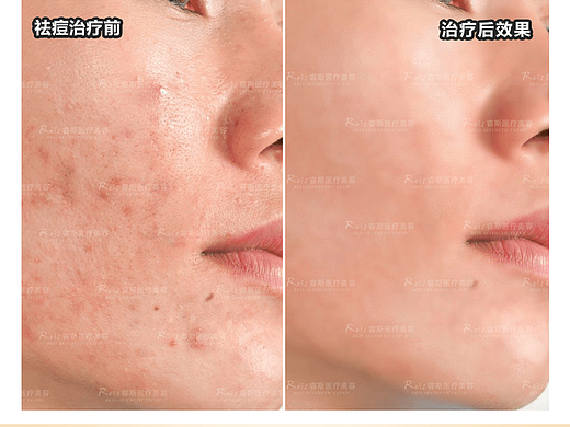 医美皮肤科案例对比图