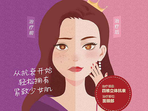 医美 宣传手绘长图