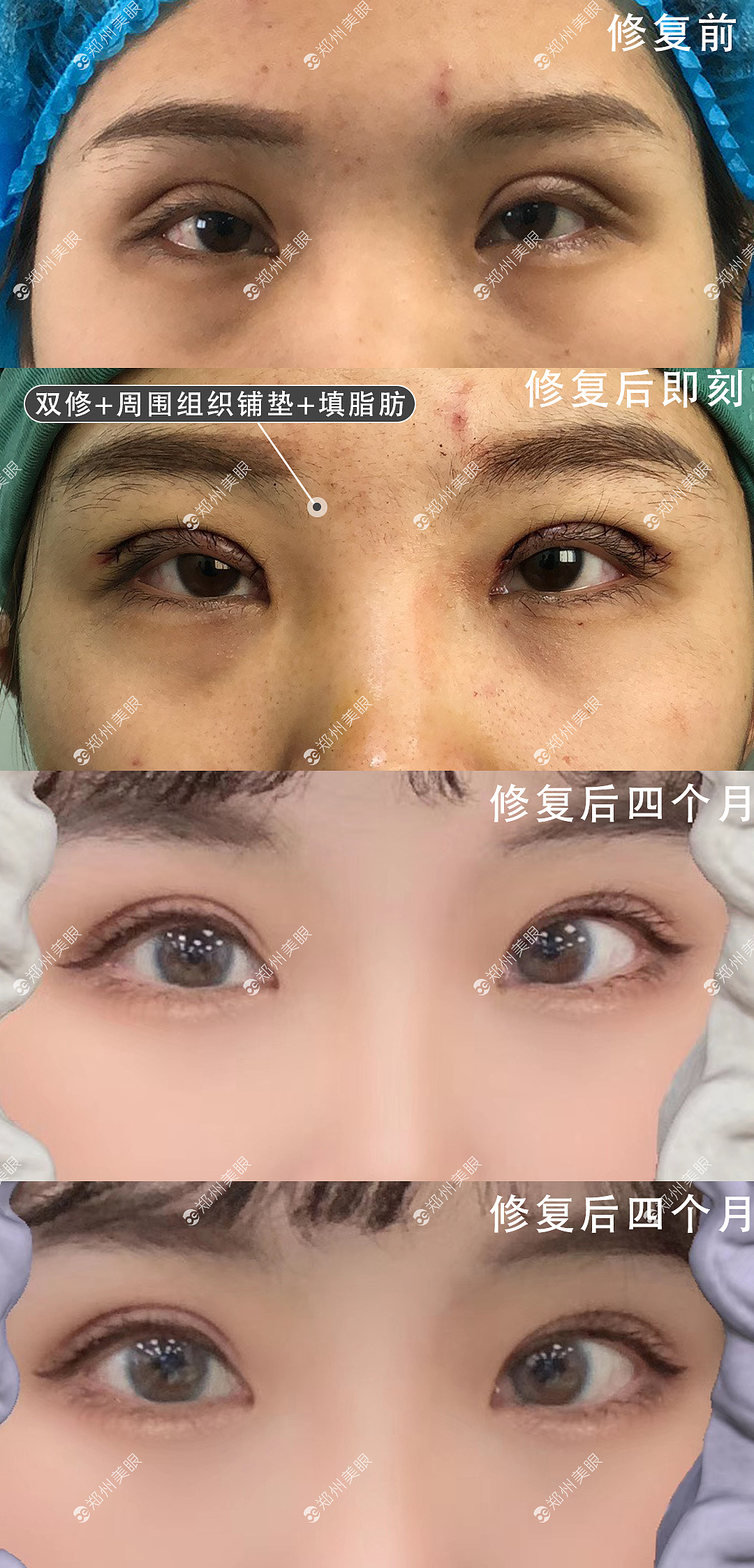 双眼皮修复田氏切开修复效果图（图ZMjA2Mjk0NDYw） - 其他 - 站酷设计师郑州双眼皮医生原创素材 - 站酷ZCOOL