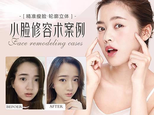 医美案例模板整形案例美容案例海报医美朋友圈案例图