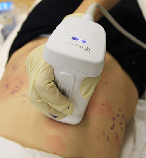 美容仪器热立塑治疗头