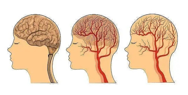 科普短视频-脑供血不足