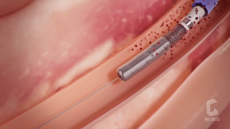 心脏支架手术医疗动画展示片