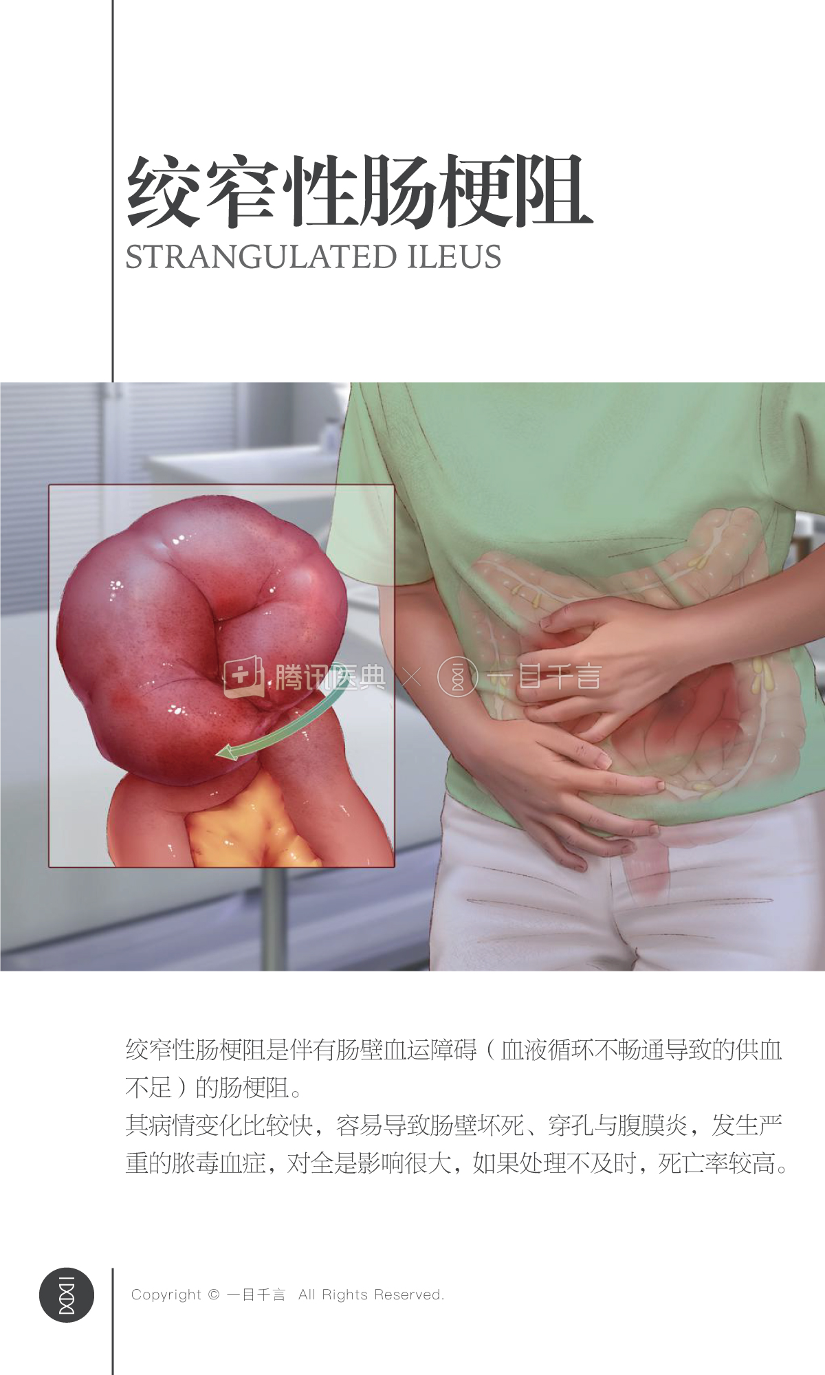 血运性肠梗阻图片