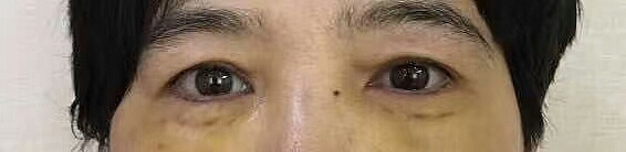 郑州袪眼袋手术,摆脱眼袋问题过程分享（图ZMjI0NTY0Mjg0） - 其他 - 站酷设计师郑州双眼皮医生原创素材 - 站酷ZCOOL