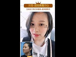北京英煌名醫(yī)丨肋骨隆鼻 全過(guò)程對(duì)比