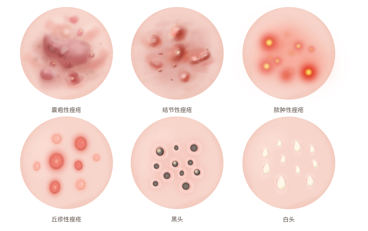 祛痘专题页（图ZMjQyMDQ3MDI4） - e-commerce - 站酷设计师闲散设计叔原创素材 - 站酷ZCOOL