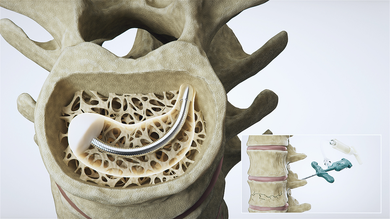 【产品动画】朗迈SPKP操作演示（图ZMzMyMjczNTQ4） - 动画/影视 - 站酷设计师LIDODESIGN原创素材 - 站酷ZCOOL