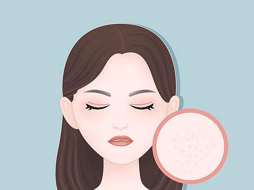 医美、脸部、痘痘、粉刺