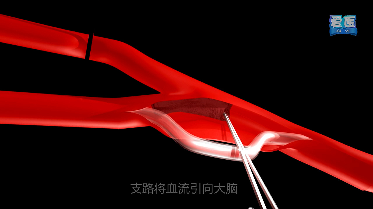 三维动画血栓（图ZMTgzMDI0NTQ0） - 栏目片头 - 站酷设计师感动原创素材 - 站酷ZCOOL