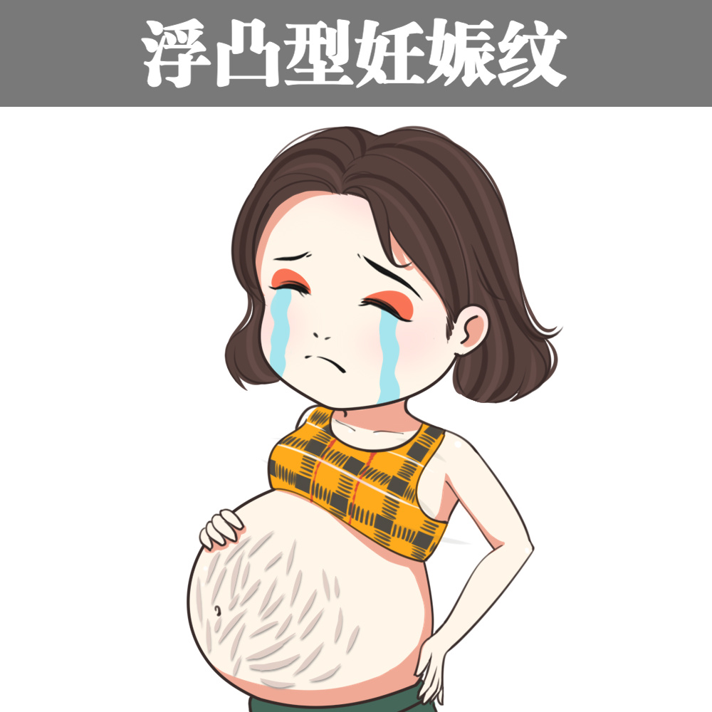 妊娠纹类型
