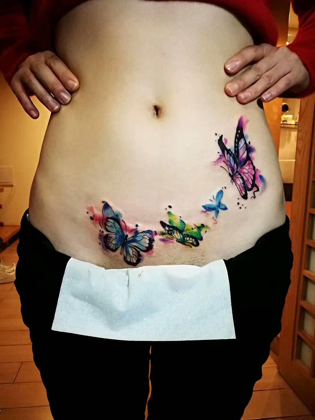 无锡皮秒激光洗纹身,皮秒+点阵淡斑美肤祛除痘坑痘印