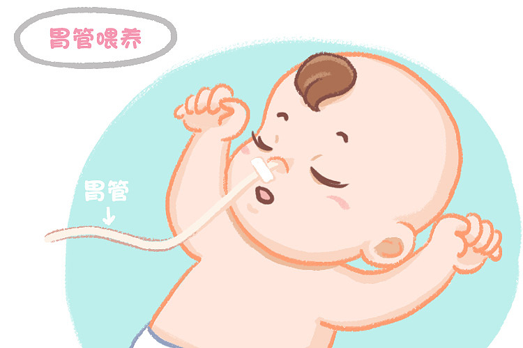 在没有足够能力经口吸吮喂养以前,通常采用胃管喂养,即通过口腔插一根