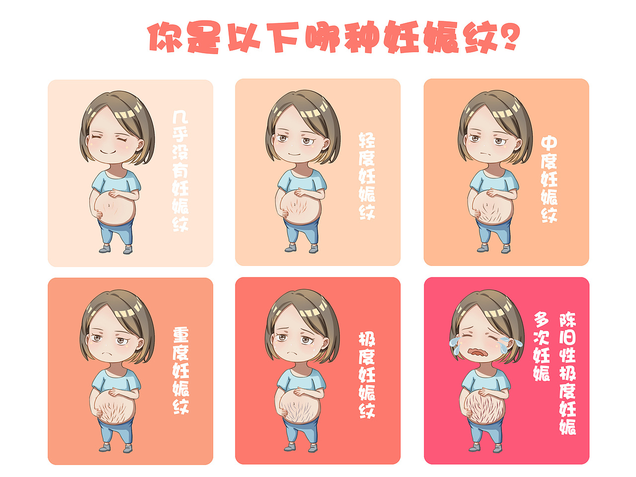 医疗插图——妊娠纹