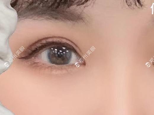 终于能出门了！双眼皮成功修复分享