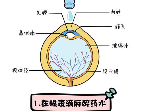 人工晶体植入