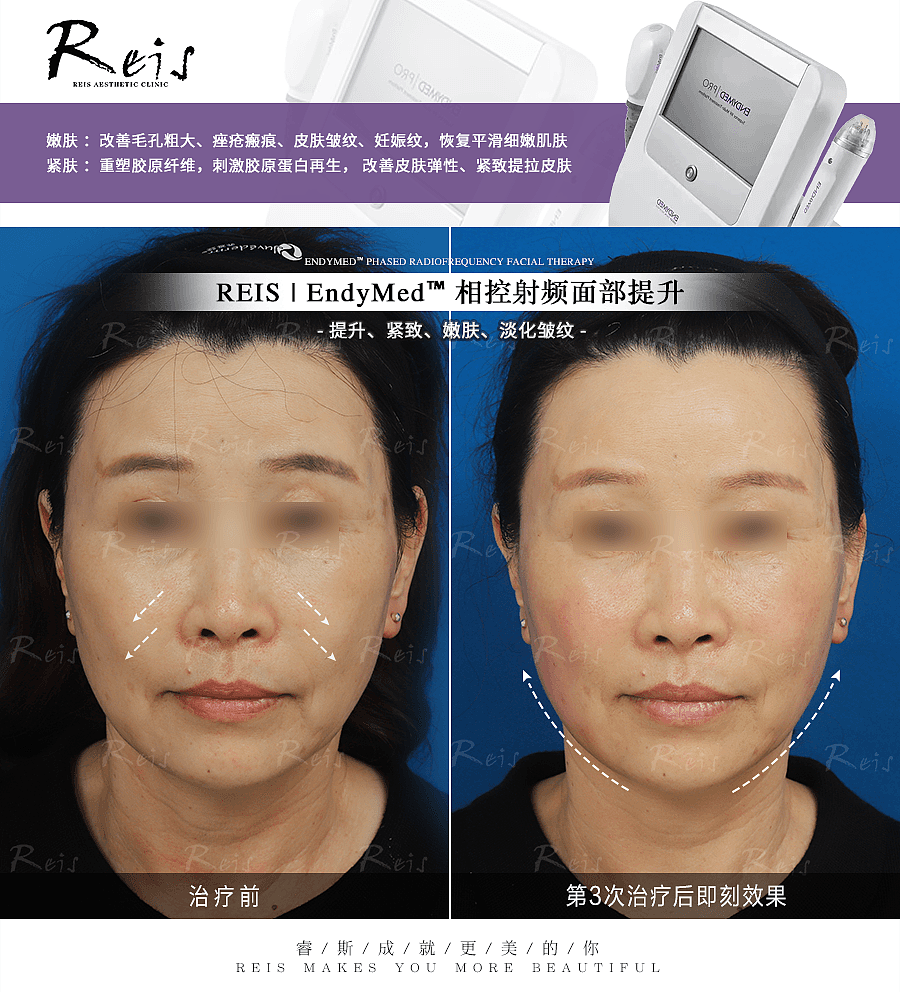 医美皮肤科案例对比图