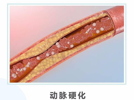 动脉硬化详情页
