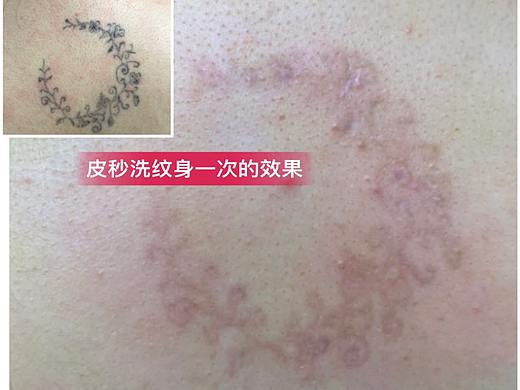 无锡皮秒洗纹身和激光洗纹身有什么区别哪个效果更好？