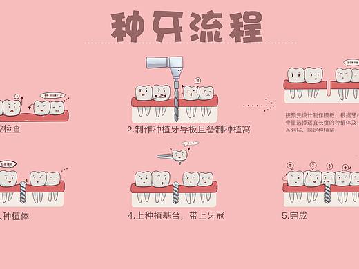 种牙流程（个人主页-ZNDAzMjA0Mjg=） - 创作习作 - 站酷设计师刘玉美口腔插画原创素材 - 站酷ZCOOL