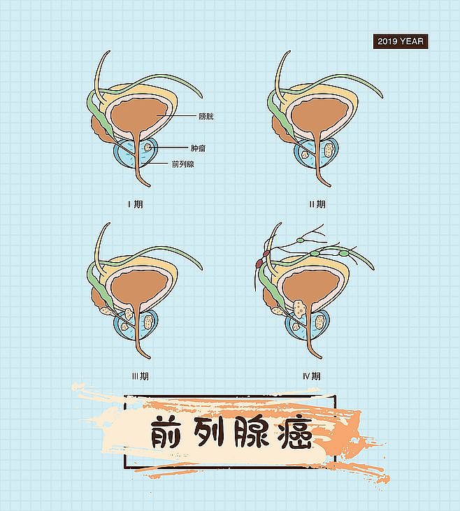 医疗泌尿系统肿瘤、前列腺癌、肾癌、健康