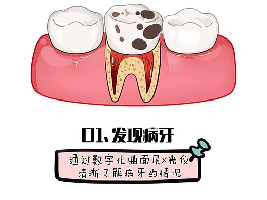 根管治疗