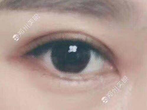 双眼皮做窄了修复双眼皮修复效果
