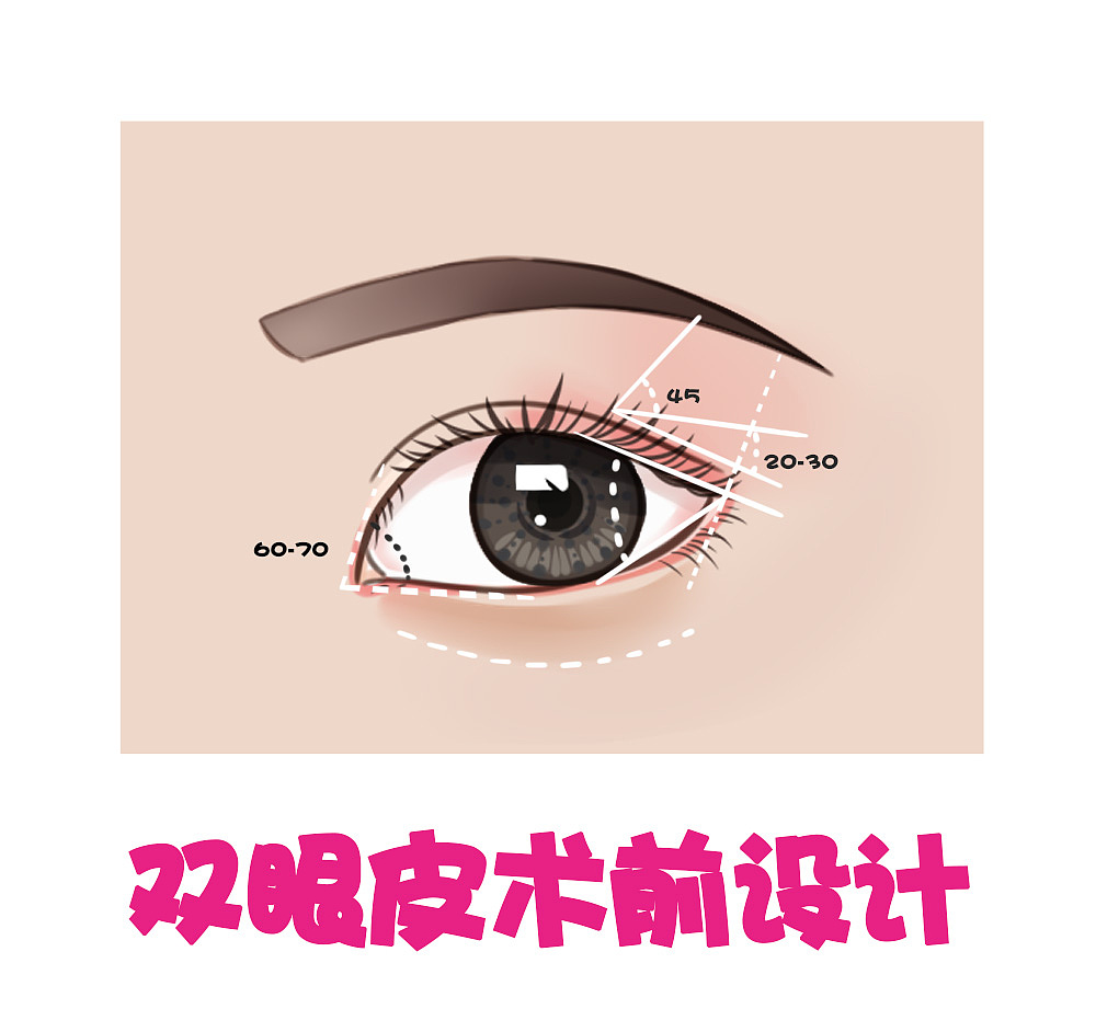 双眼皮分类--双眼皮手术设计