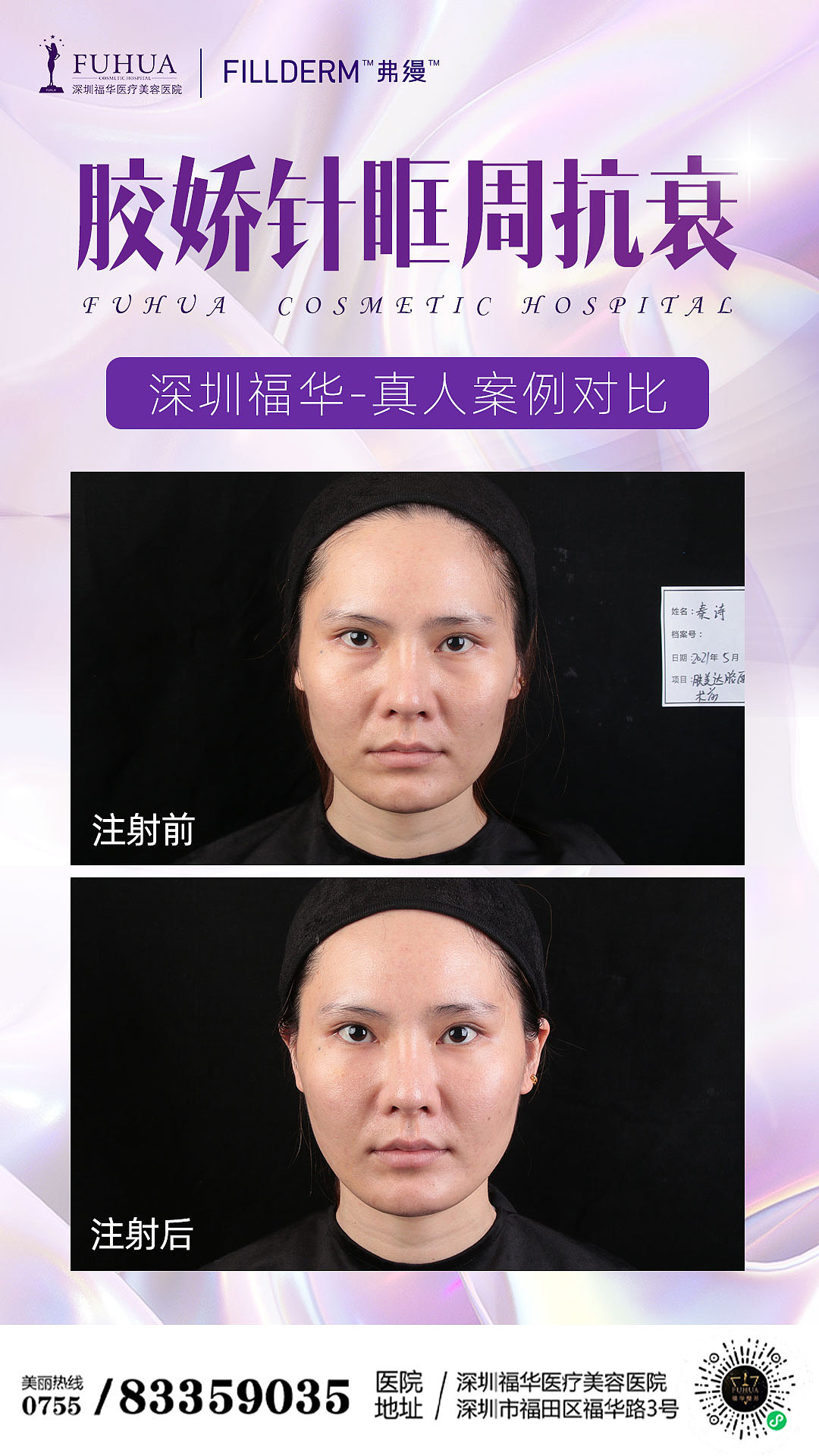 胶娇针案例对比