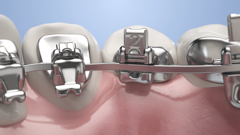 牙套产品动画（图ZMzQyOTEzOTA4） - 产品 - 站酷设计师hero影视原创素材 - 站酷ZCOOL