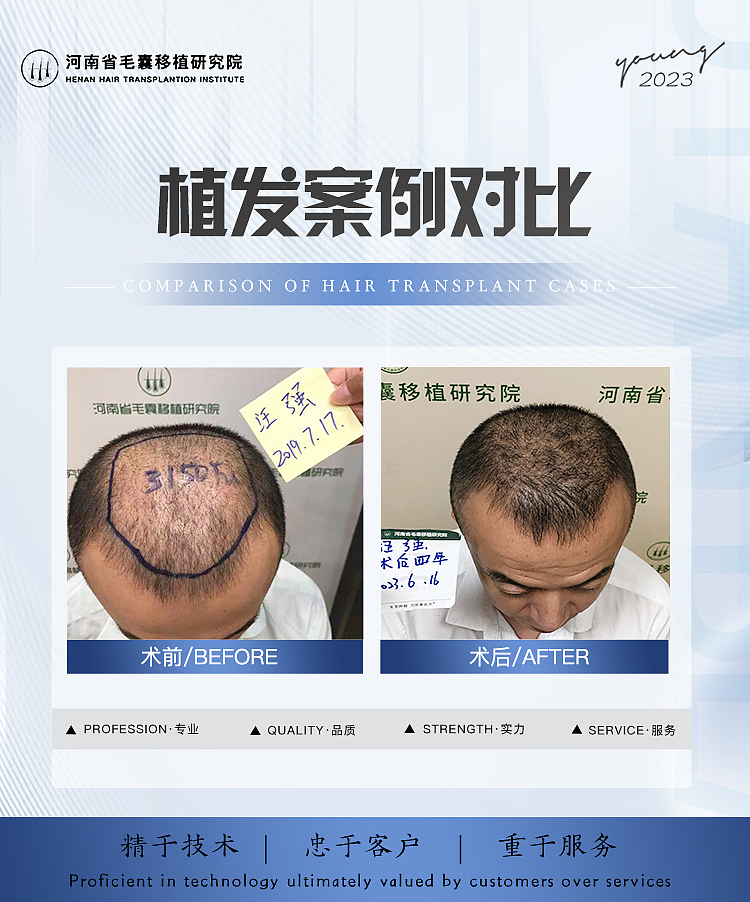 头发种植案例对比