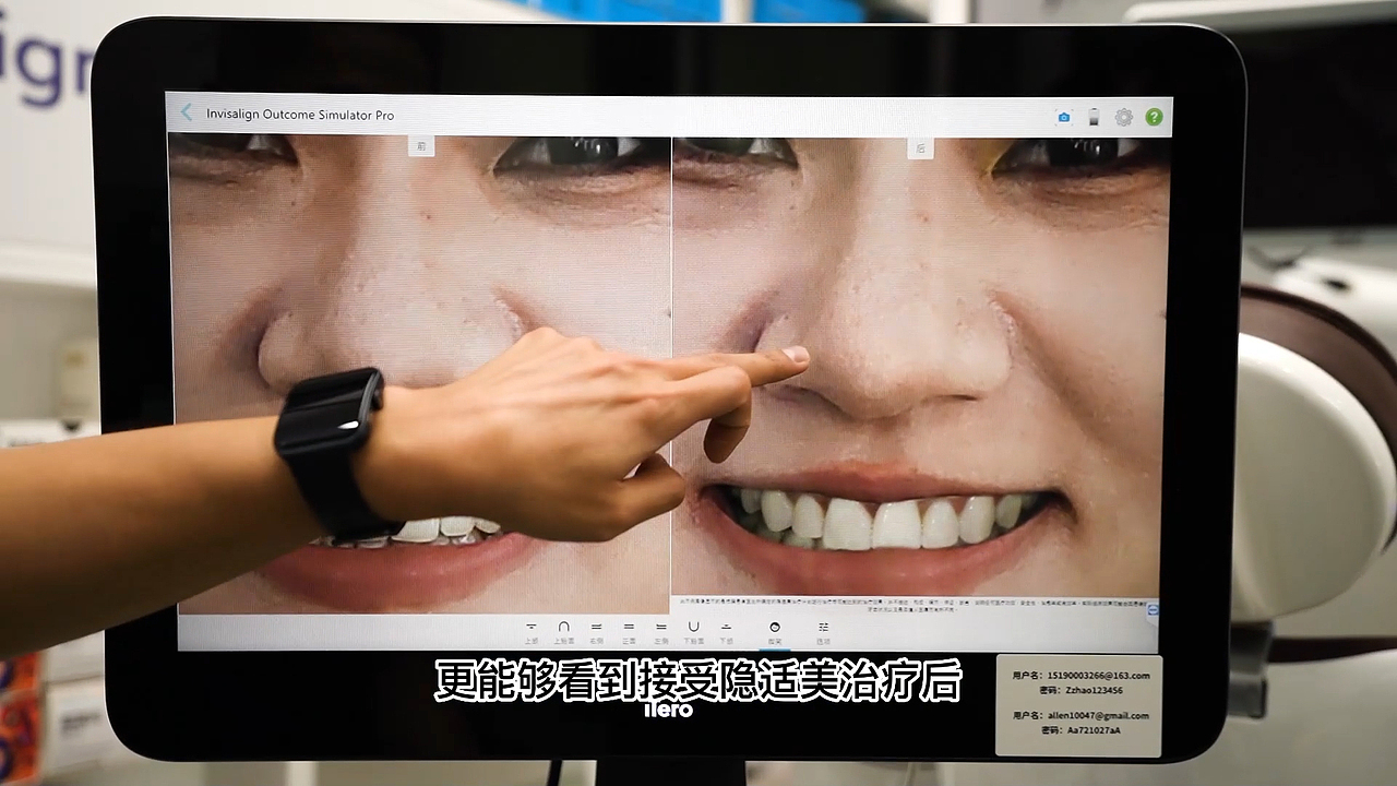 隐适美诊所系列第一期