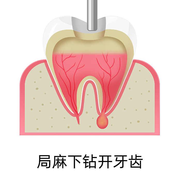 根管治療（圖ZMzA4MjU5NjQw） - 商業(yè)插畫 - 站酷設計師蜀文途話原創(chuàng)素材 - 站酷ZCOOL