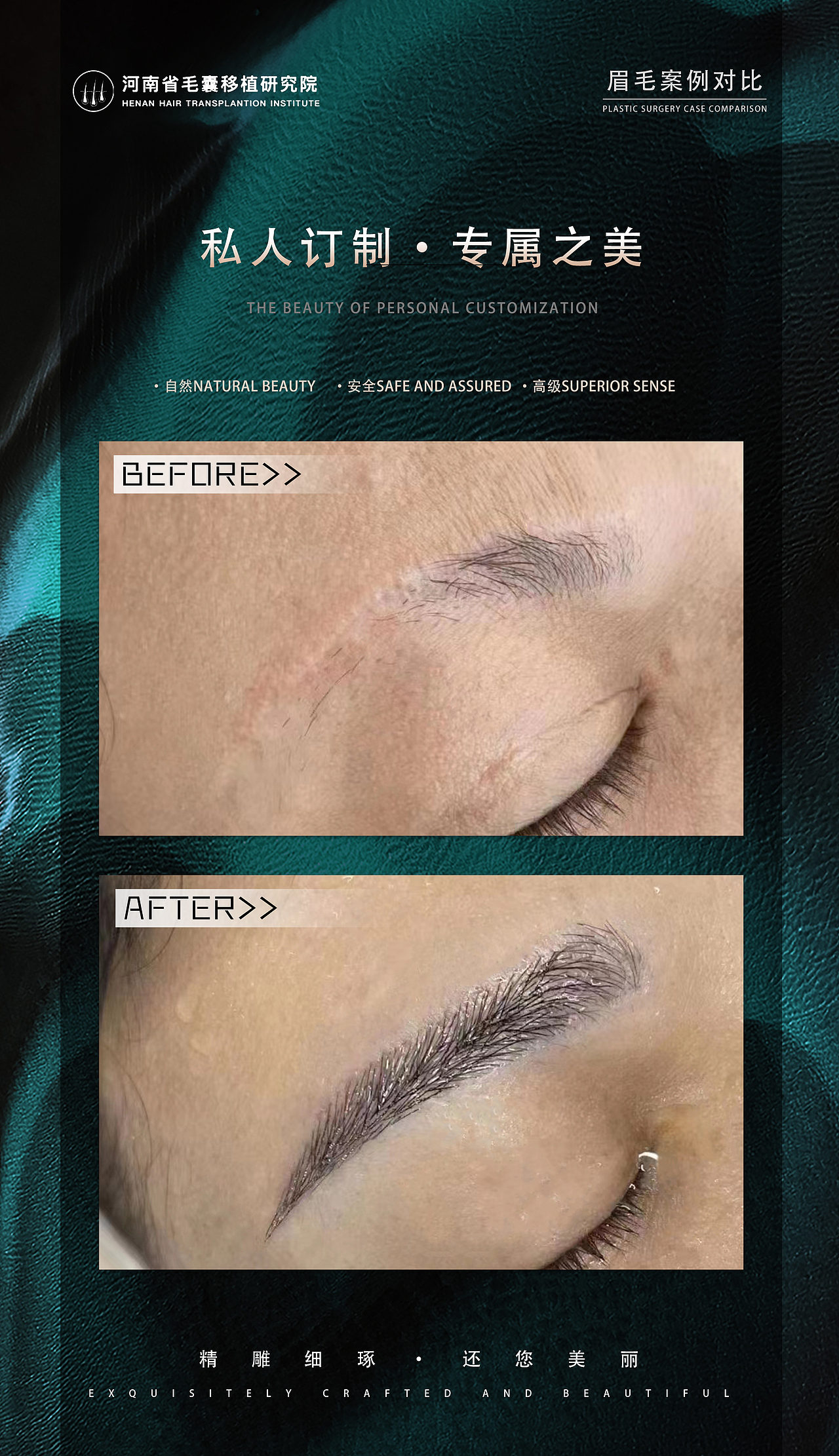眉毛种植案例对比
