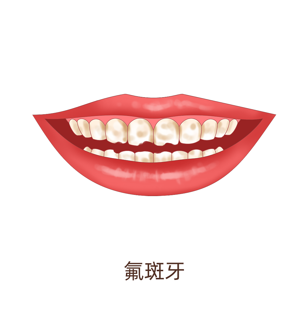 多生牙、氟斑牙、黄牙、四环素牙、牙结石（图ZMzA4MjU0NjA4） - 商业插画 - 站酷设计师蜀文途话原创素材 - 站酷ZCOOL