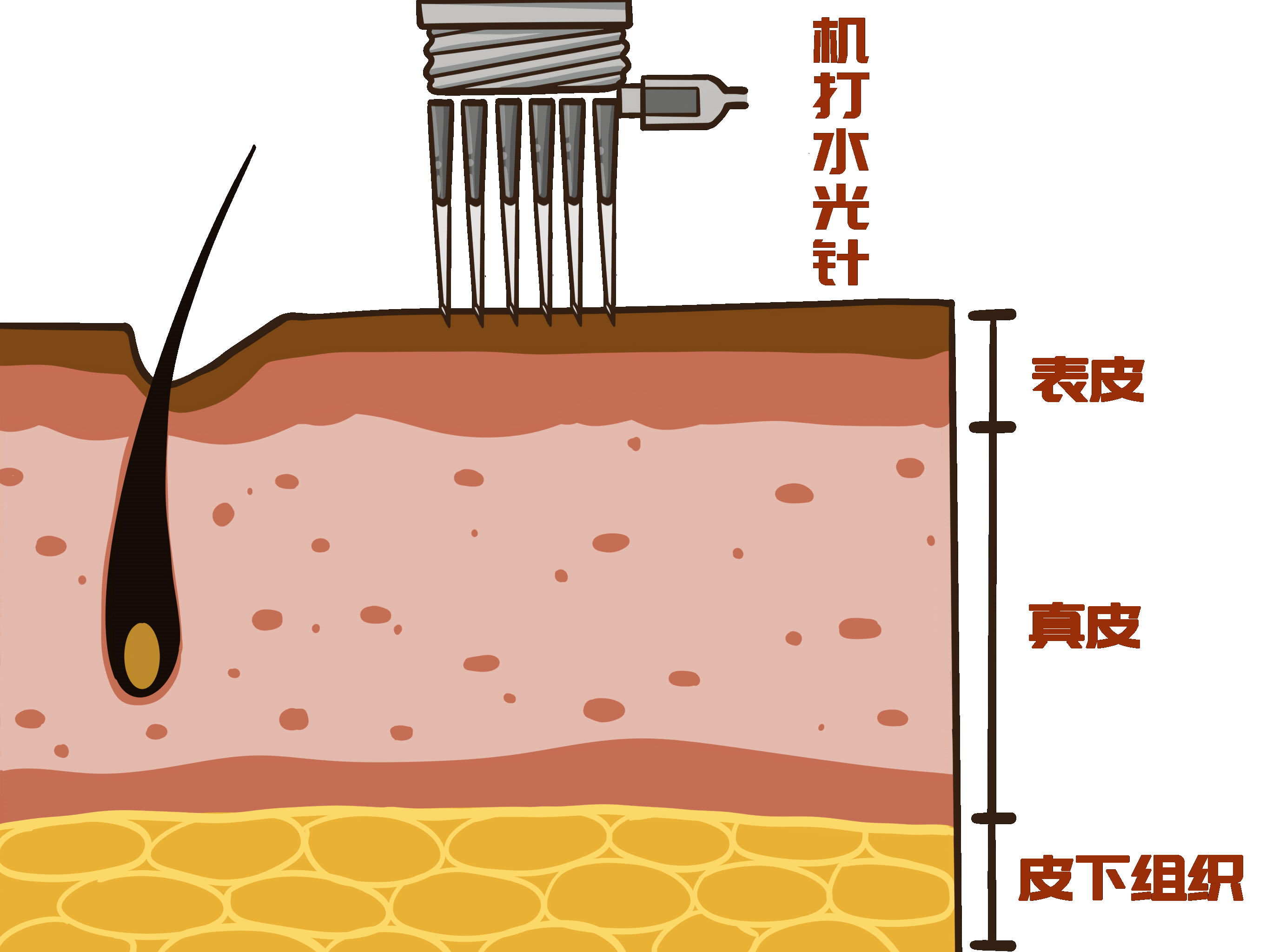 水光针手绘（图ZMzAyNDQ2NTc2） - 商业插画 - 站酷设计师小琳爱画画原创素材 - 站酷ZCOOL