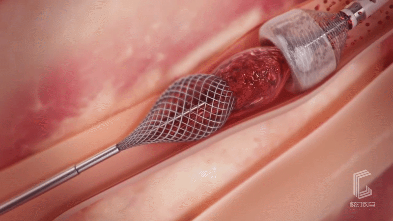 心脏支架手术医疗动画展示片