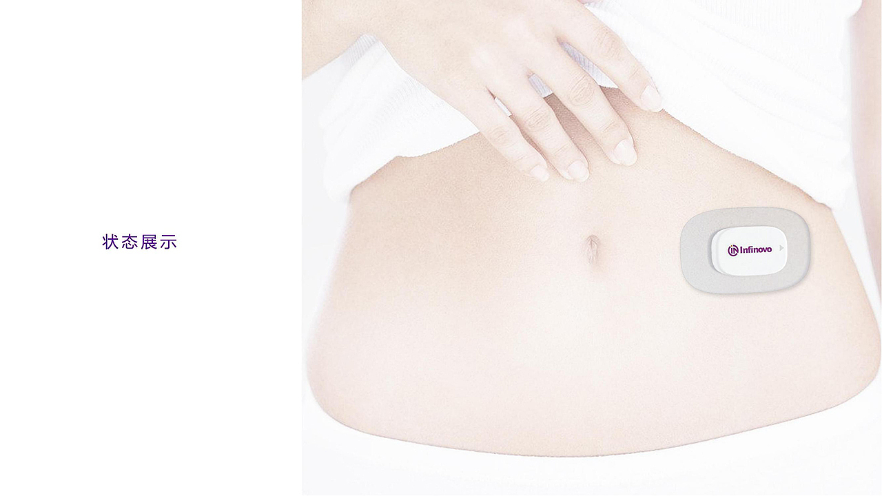 医用植入器设计