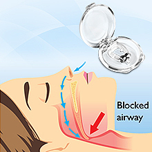 止鼾器主图A+（图ZMzQ4MzUzOTk2） - 电商 - 站酷设计师时光巷陌zf原创素材 - 站酷ZCOOL