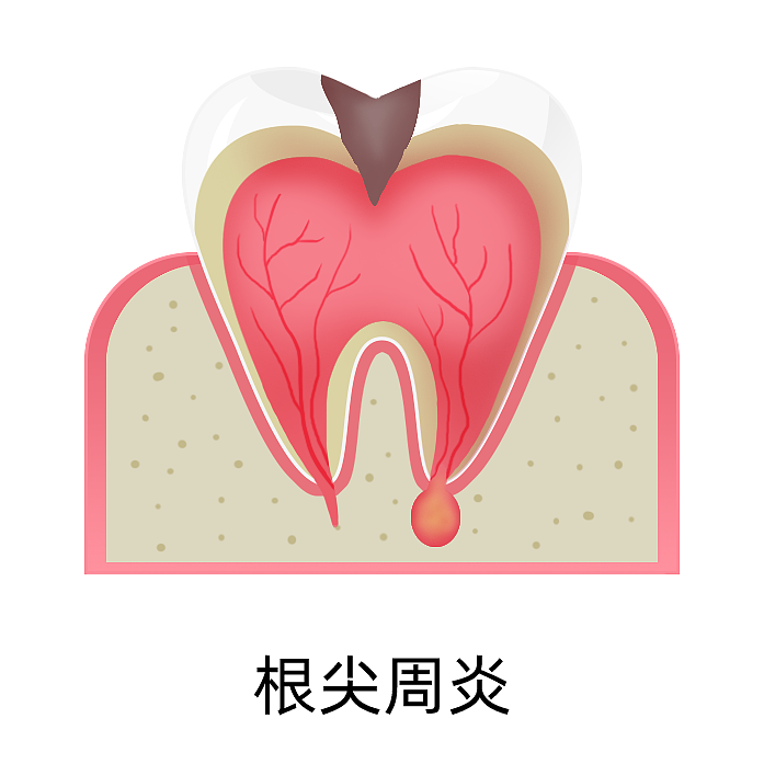 根管治療（圖ZMzA4MjU5NzIw） - 商業(yè)插畫 - 站酷設計師蜀文途話原創(chuàng)素材 - 站酷ZCOOL