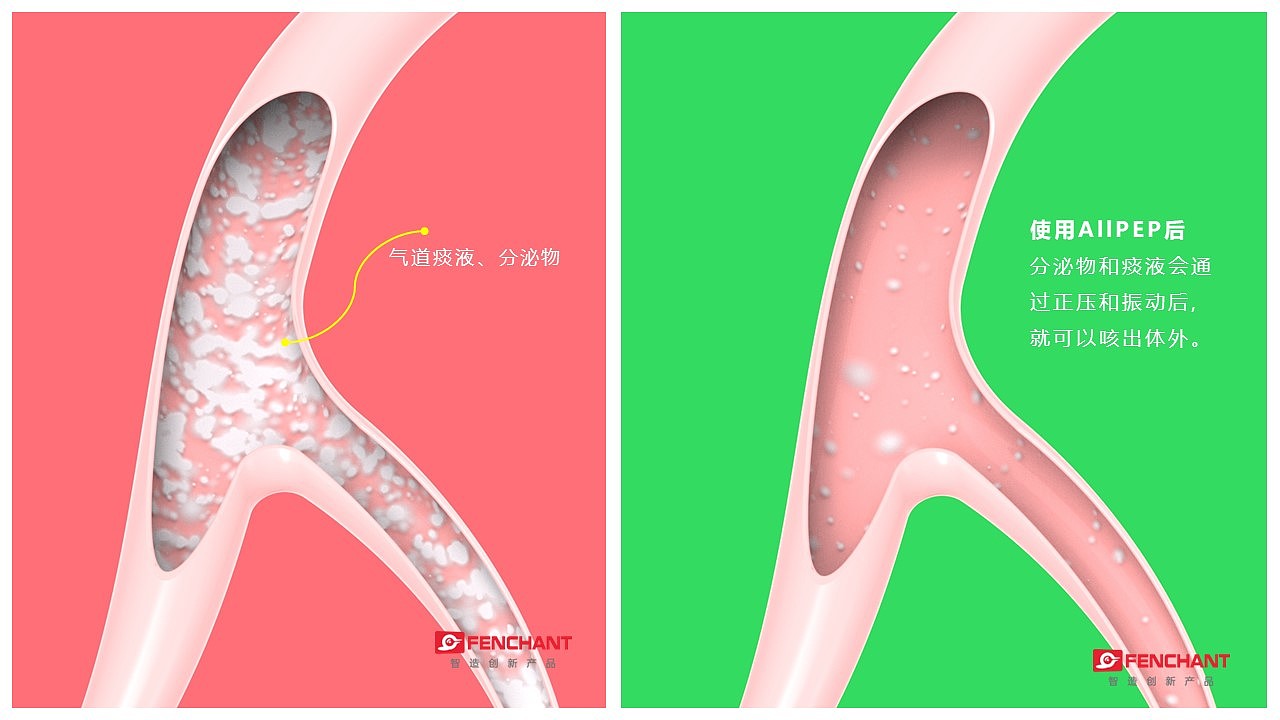 振荡式吐气正压装置 ALLPEP