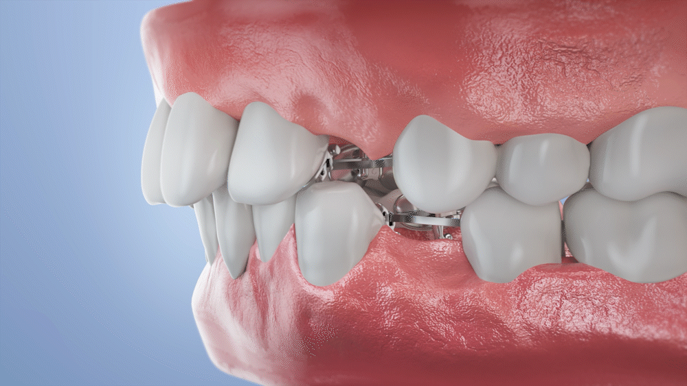 牙套产品动画（图ZMzQyOTEzNzY0） - 产品 - 站酷设计师hero影视原创素材 - 站酷ZCOOL