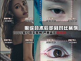 整形案例-网红风