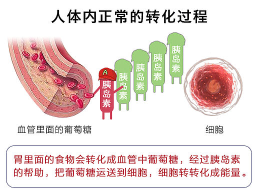医疗科普文章，糖尿病