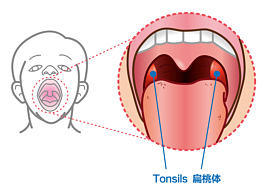 【AI繪圖】扁桃體腺樣體示意圖